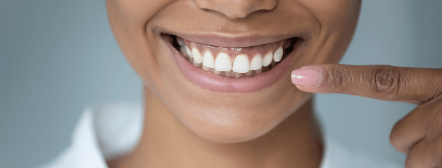 3 Tricks to Get Straight Teeth - Springtime Hills Family Dental